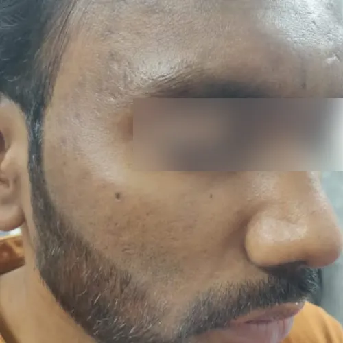 Skin after treatment at Pigment Plus