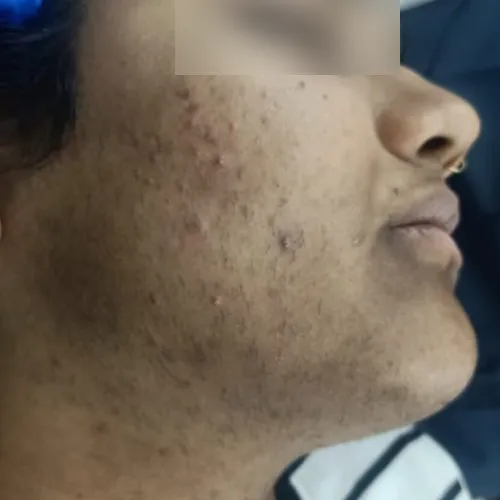 Skin before treatment at Pigment Plus