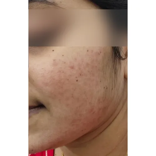 Skin after treatment at Pigment Plus