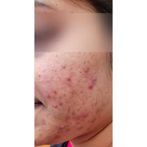 Skin before treatment at Pigment Plus