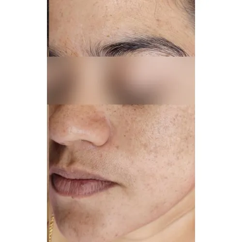 Skin after treatment at Pigment Plus
