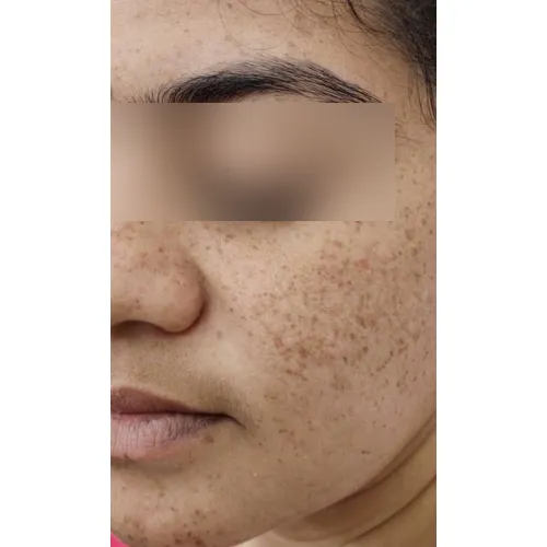 Skin before treatment at Pigment Plus