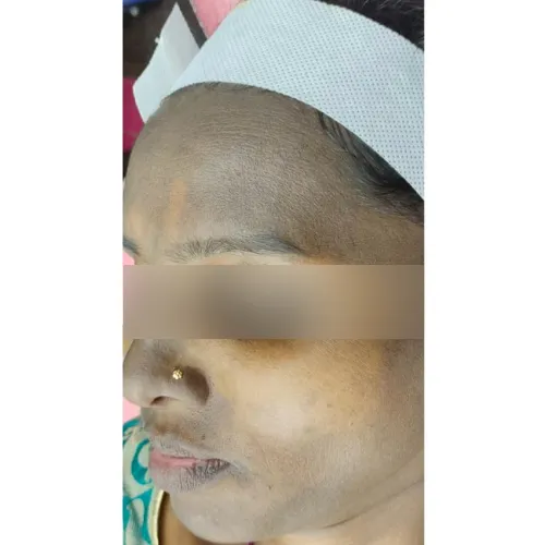 Skin after treatment at Pigment Plus