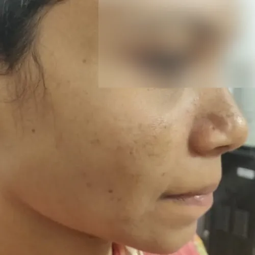Skin after treatment at Pigment Plus