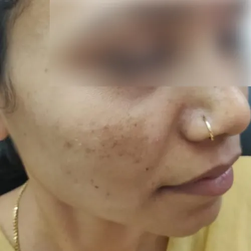 Skin before treatment at Pigment Plus
